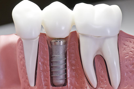 Dental Implants Manchester