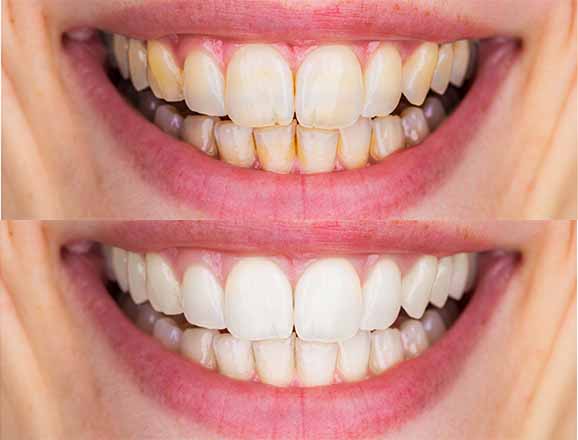 Teeth Whitening Manchester